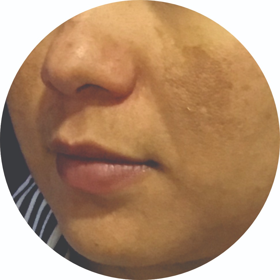 Melasma 